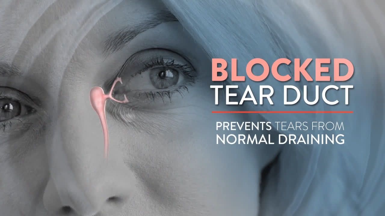 Clogged Blocked Tear Duct Pictures Adults Trend Meme 