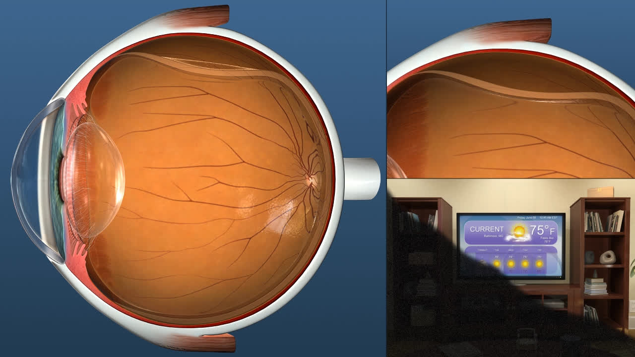 torn retina vision