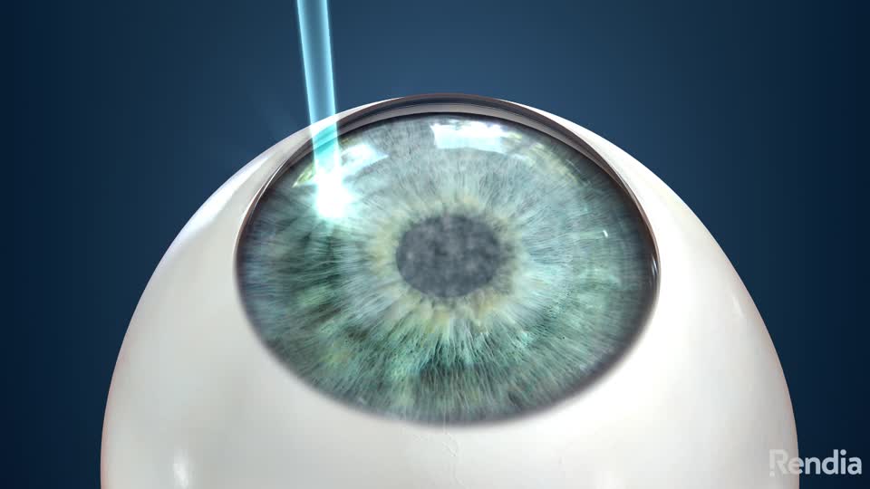 Dougherty Laser Vision - Vision Correction Surgery - Home - Facebook