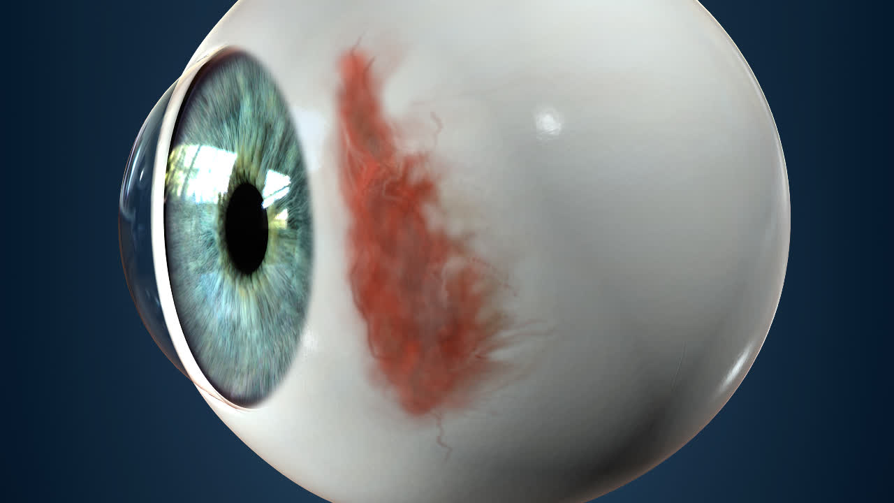 Australische wetenschappers boeken succes met bionisch oog - ICT&health