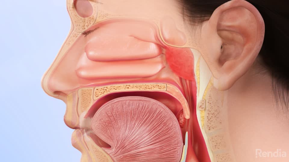 Tonsils And Adenoids Ent Health