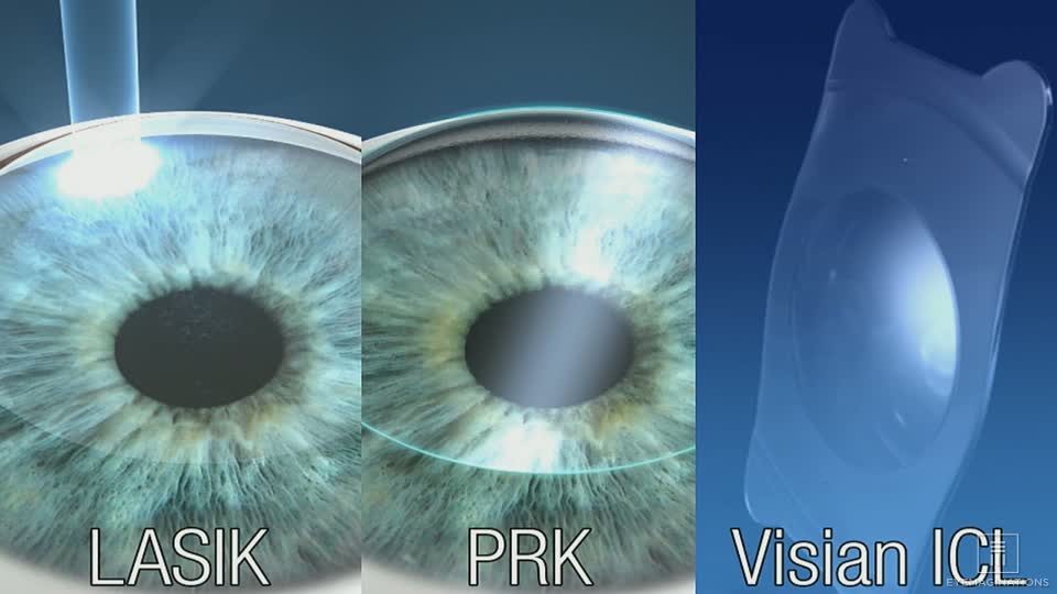 Lasik Vs Icl Eye Care And Lasik In Atlanta Georgia Woodhams Eye Clinic