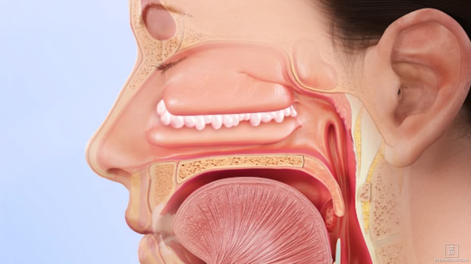 recurring nasal polyps