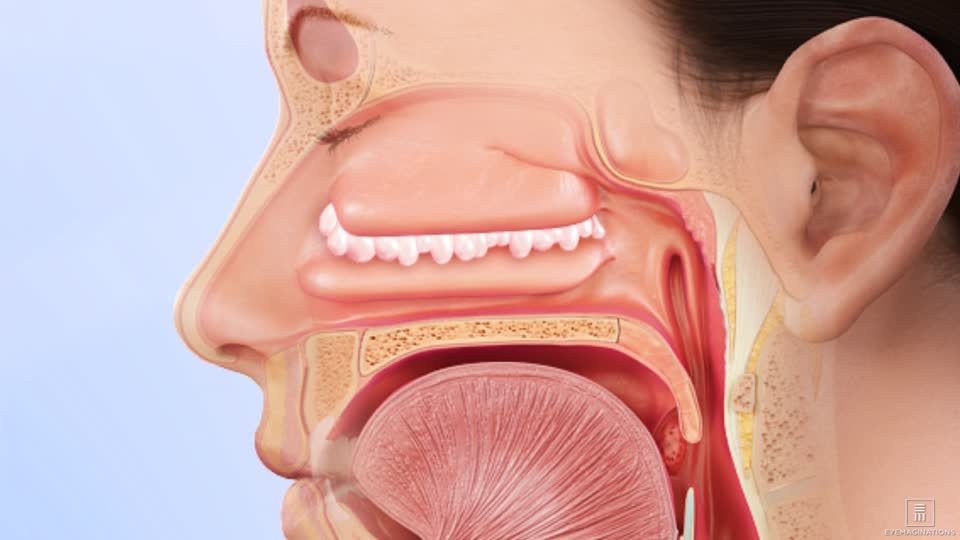 nasal polyps and sinus infection