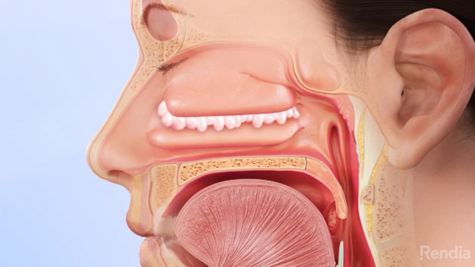 painful nasal polyps